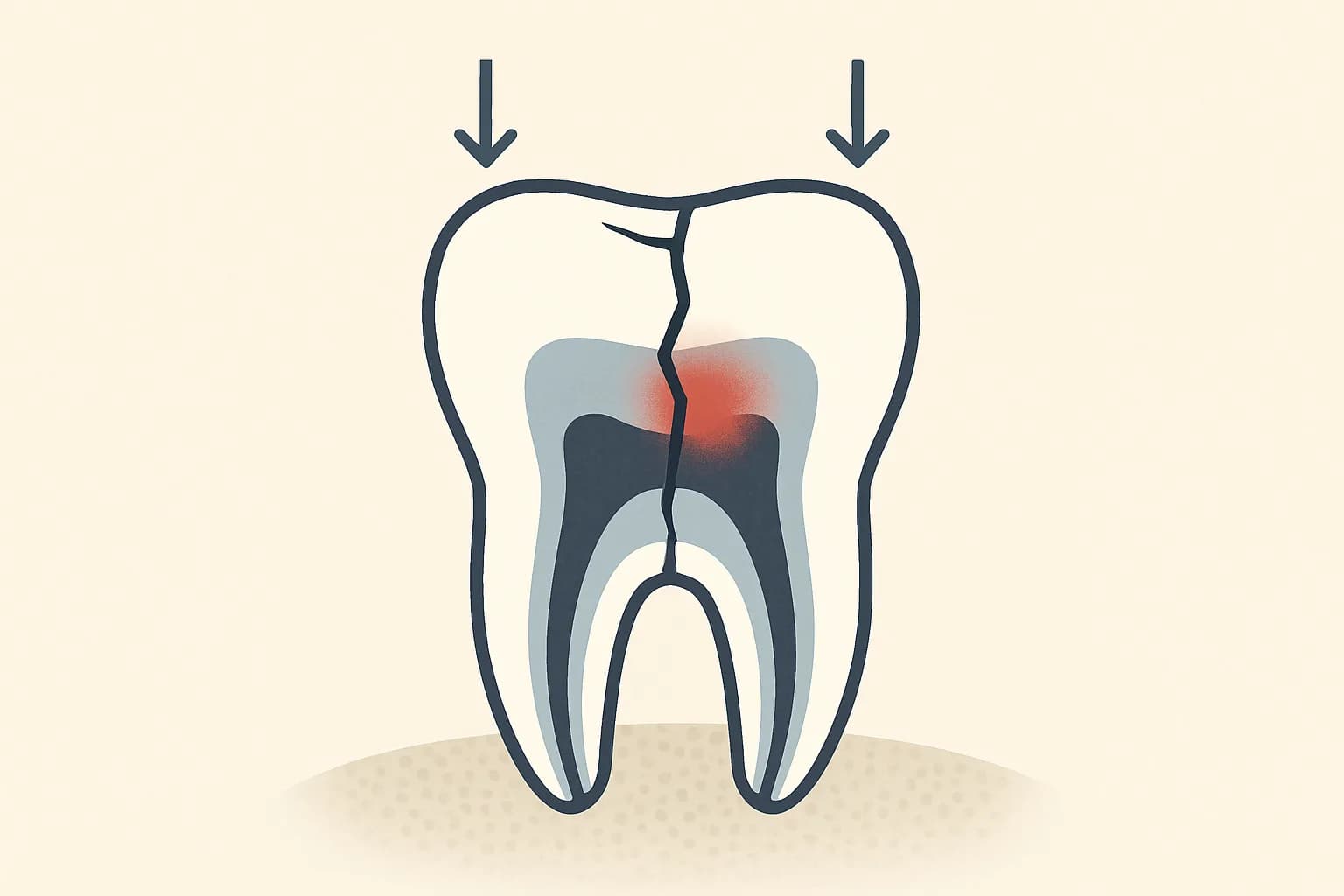 Editorial illustration for When Is a Cracked Tooth a Dental Emergency in Palo Alto?
