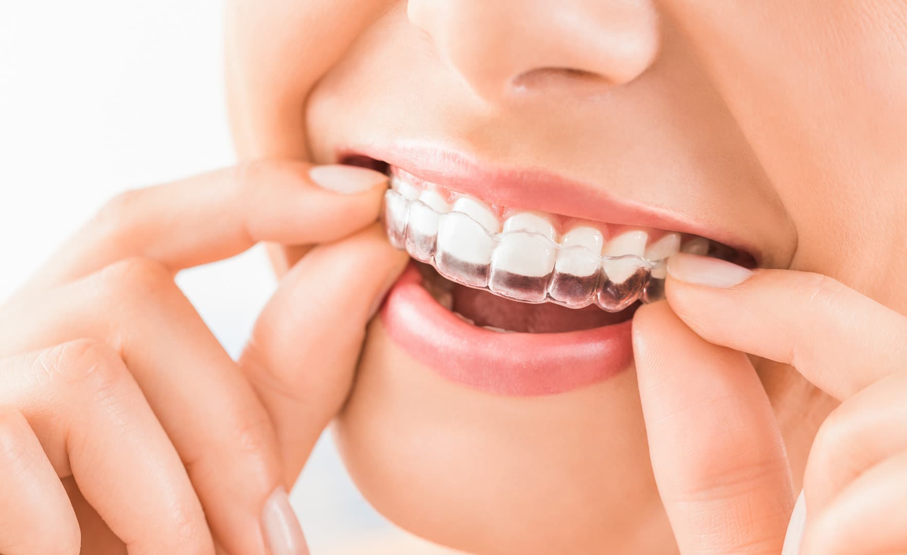 Invisalign clear aligners treatment at Dr. Christopher B. Wong's Palo Alto practice